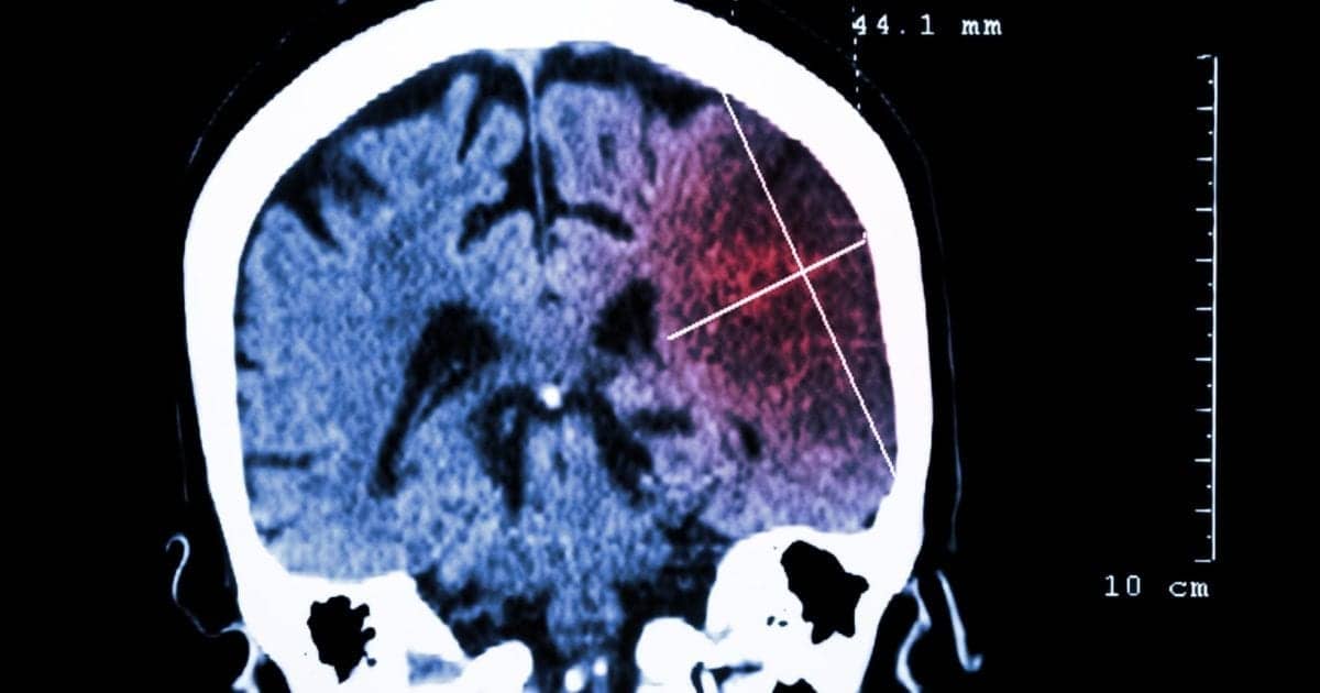 Sleep Wake Disturbances Can Predict Recurrent Strokes Sleep Review